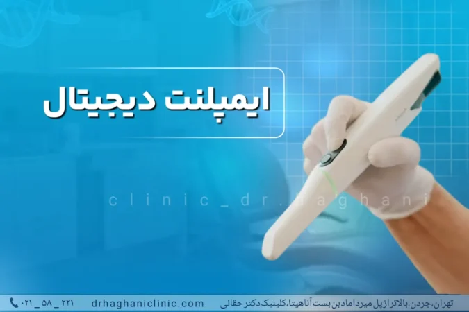 ایمپلنت دیجیتال