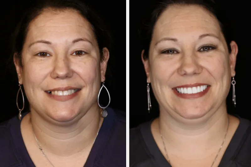 تأثیر ایمپلنت بر فرم لبخند