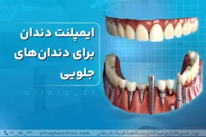 ایمپلنت دندان جلویی