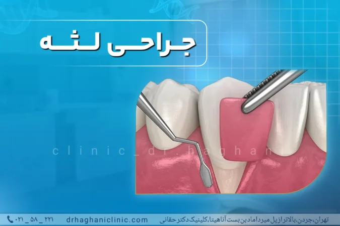 جراحی لثه