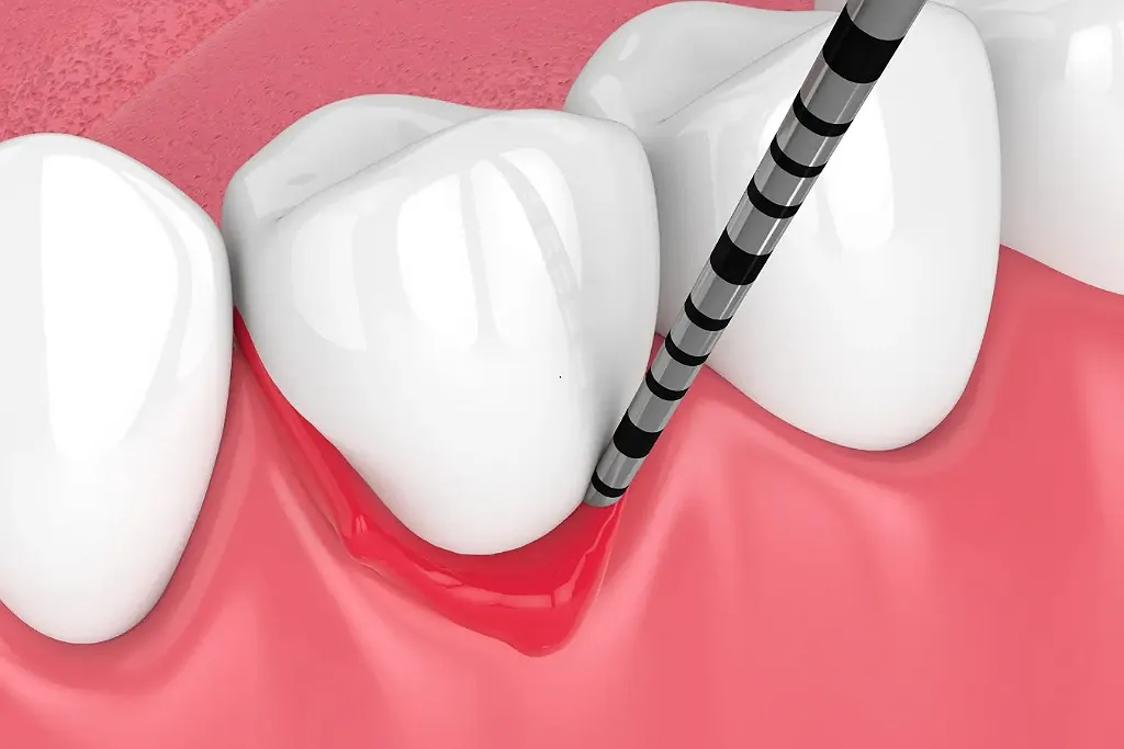 مزایای جراحی لثه برای ایمپلنت