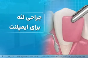جراحی لثه برای ایمپلنت دندان