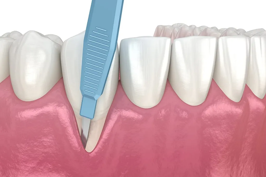 جراحی لثه برای ایمپلنت در کلینیک دکتر حقانی