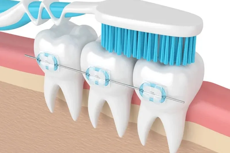 اهمیت مراقبتهای خانگی پس از ایمپلنت