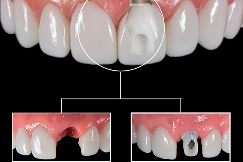ترمیم بعد ایمپلنت