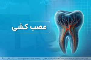 عصب کشی دندان در شمال تهران