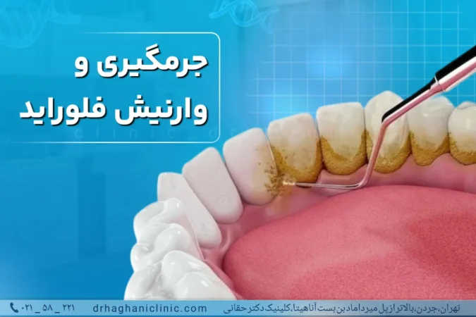 جرم‌گیری و وارنیش فلوراید در کلینیک دندانپزشکی دکتر حقانی در میرداماد