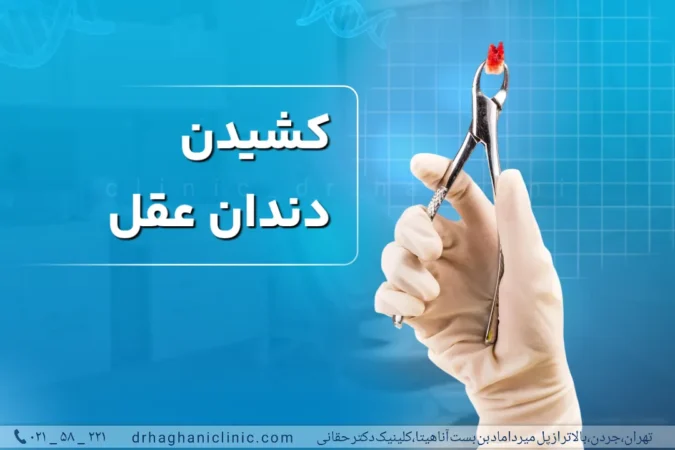 کشیدن دندان عقل سریع و بدون درد