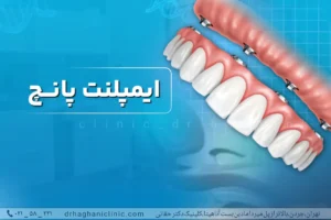 ایمپلنت پانچ بدون جراحی