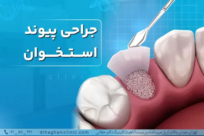 جراحی پیوند استخوان در کلینیک دندانپزشکی دکتر حقانی