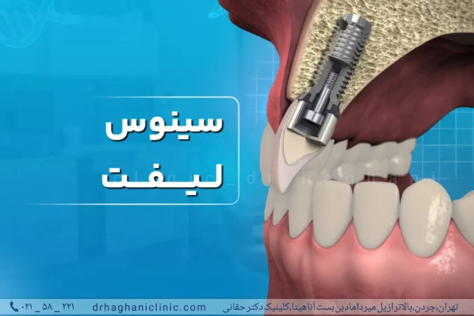 جراحی سینوس لیفت در تهران