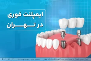 ایمپلنت فوری در تهران