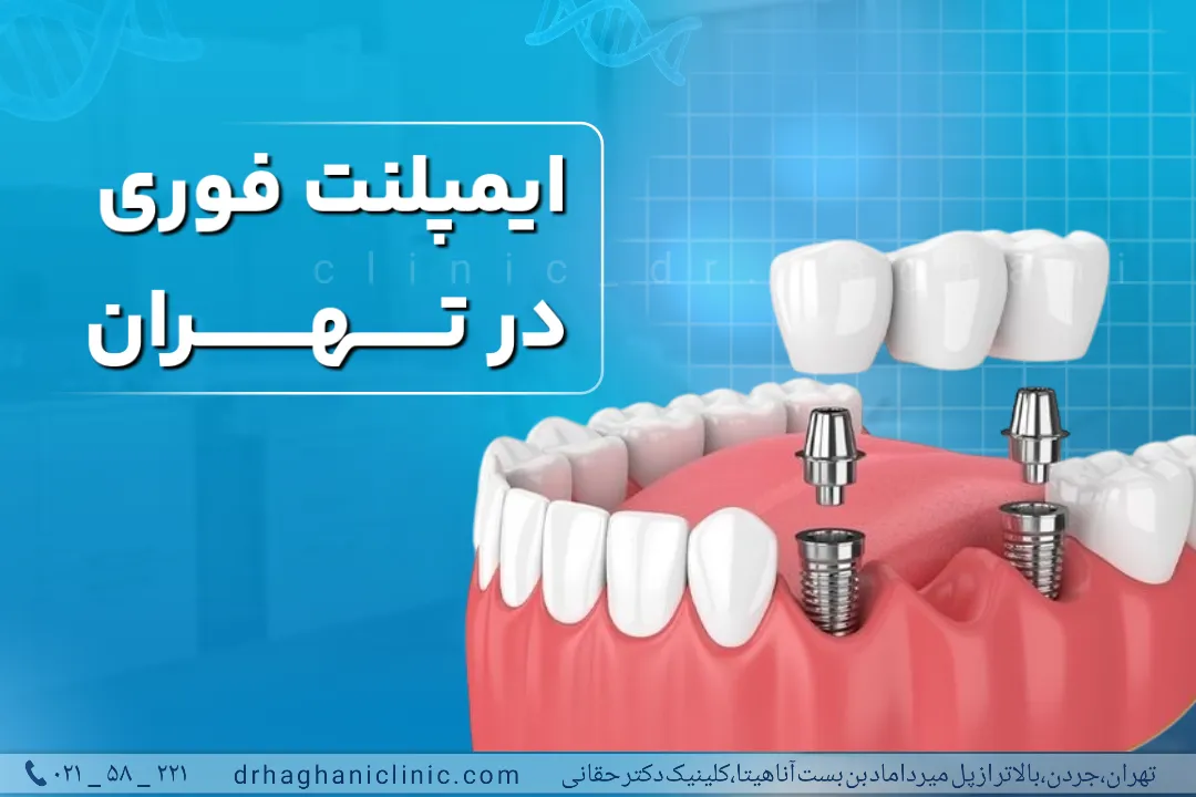 ایمپلنت فوری در تهران