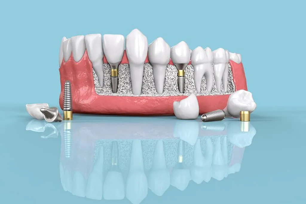 ایمپلنت دیجیتال دندان در کلینیک دندانپزشکی تامین سلامت ایرانیان در تهران