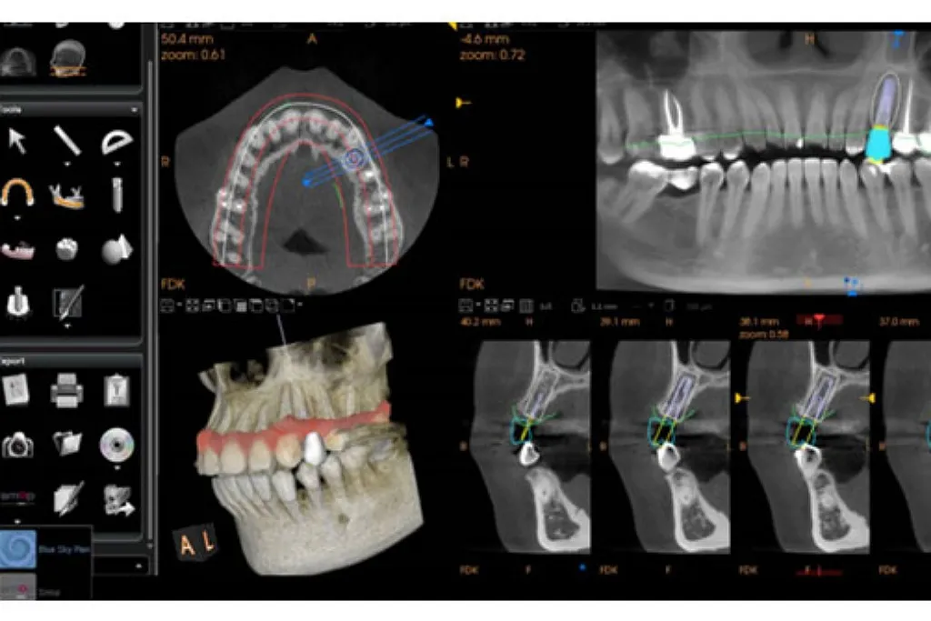 ایمپلنت دیجیتال دندان با روش های نوین