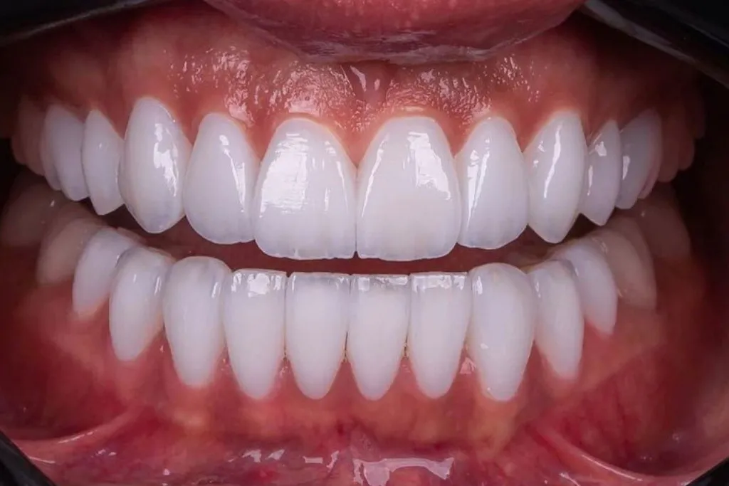 تفاوت لبخند هالیوودی با بلیچینگ و ارتودنسی