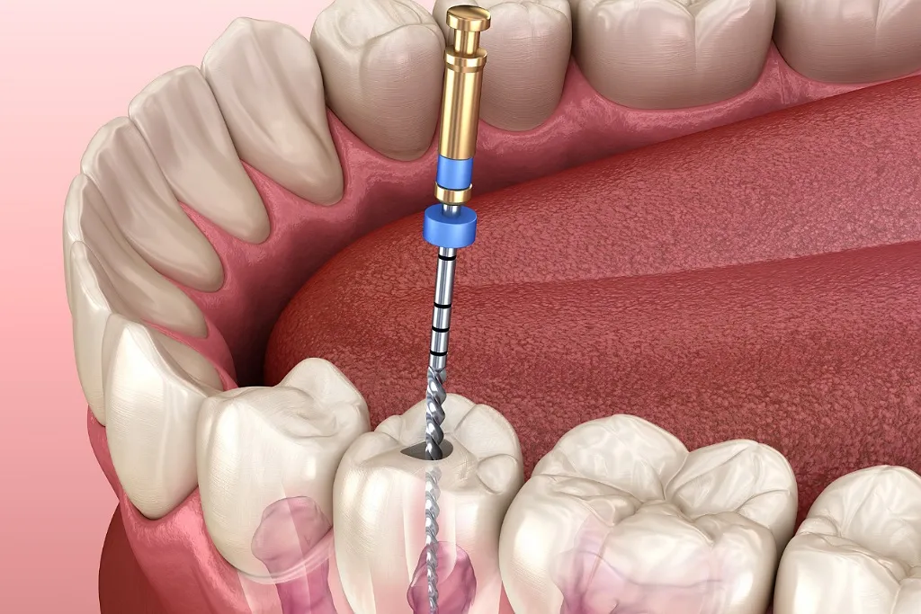 عصب کشی دندان در کلینیک دکتر حقانی تهران