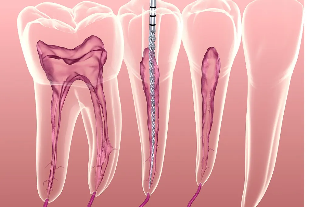 عصب کشی دندان ها بدون درد در کلینیک حقانی