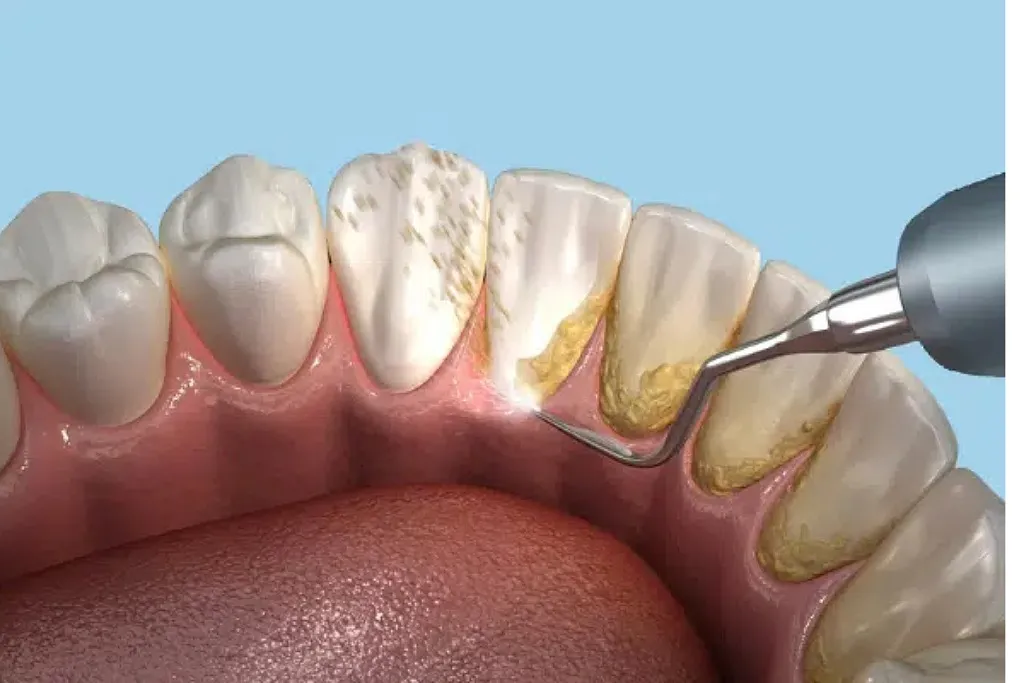 جرم گیری و وارنیش دندان