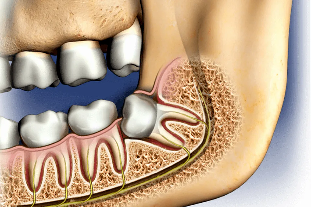 جراحی دندان نهفته در تهران 