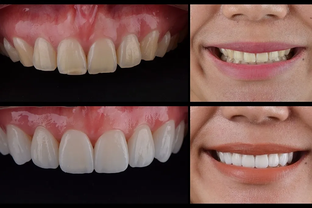 مزایای کامپوزیت دیجیتال 