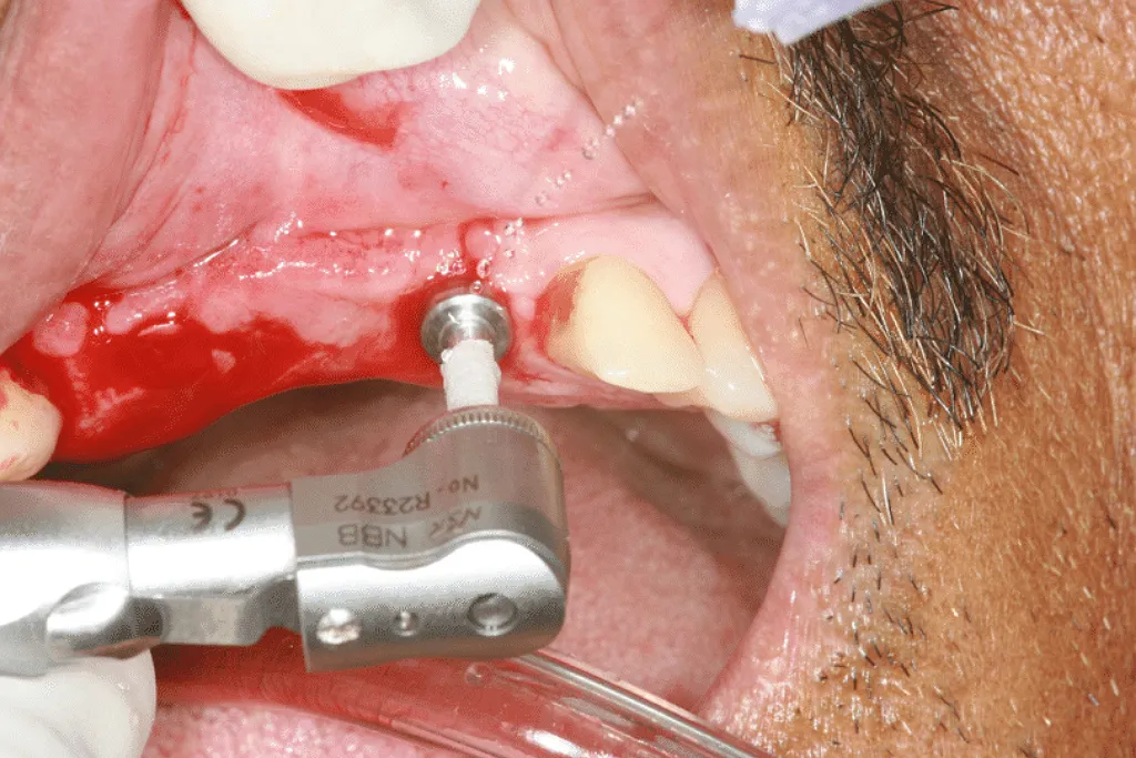 معرفی خدمات ایمپلنت پانچ در کلینیک دندانپزشکی دکتر حقانی