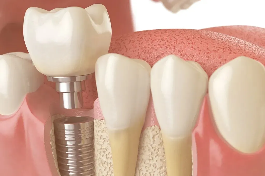 معرفی خدمات جراحی پیوند استخوان در کلینیک دندانپزشکی دکتر حقانی