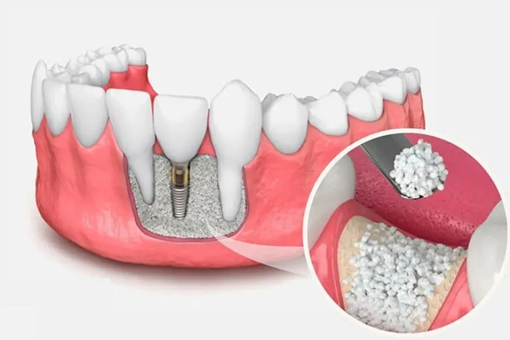 جراحی پیوند استخوان در تهران 