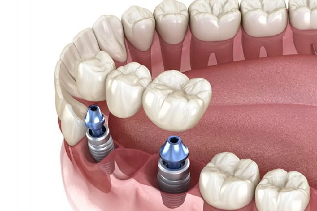 ایمپلنت فوری بادوام بالا