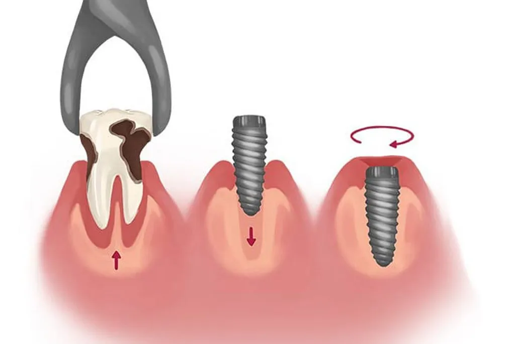 مزایای ایمپلنت فوری دندان در کلینیک دندانپزشکی دکتر حقانی