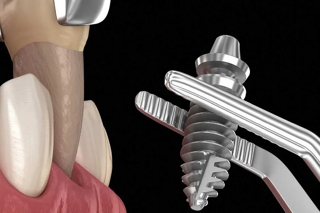 کلینیک دندانپزشکی دکتر حقانی ارائه دهنده خدمات ایمپلنت فوری دندان