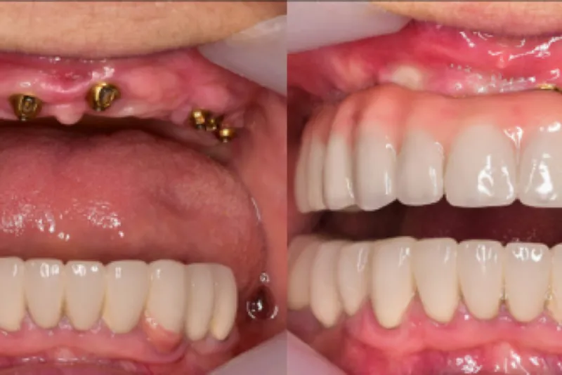 بیماری لثه و تأثیر آن بر درمان ایمپلنت