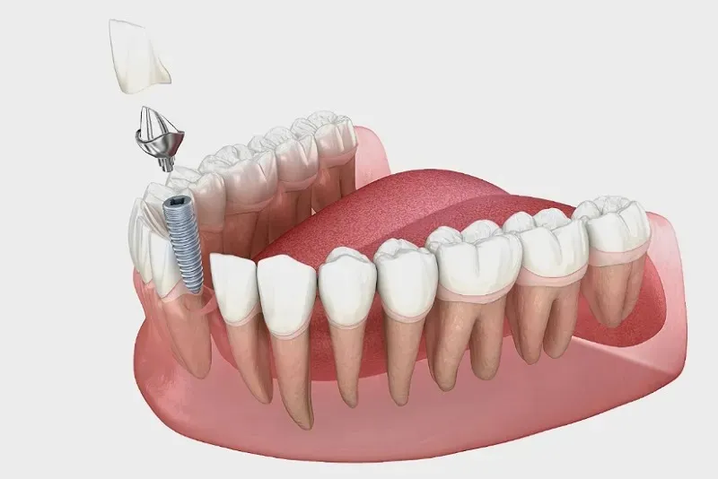 ایمپلنت دندان چیست و چه کاربردی دارد