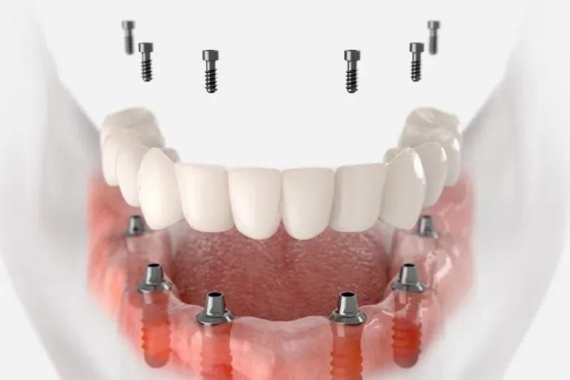 تعویض پروتز ایمپلنت