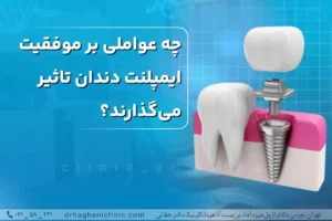 موفقیت ایمپلنت دندان