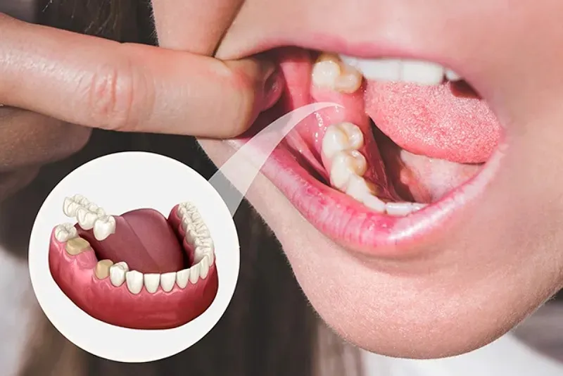 نکات مهم قبل از ایمپلنت دندان