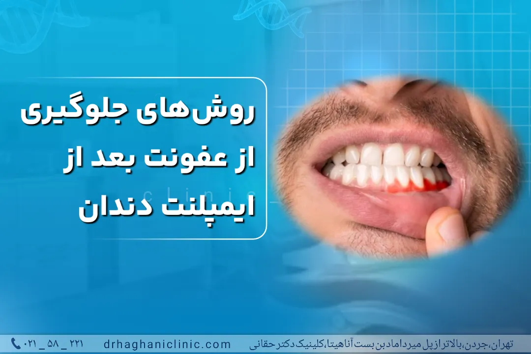 عفونت بعد ایمپلنت دندان