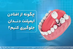 جلوگیری از افتادن ایمپلنت دندان