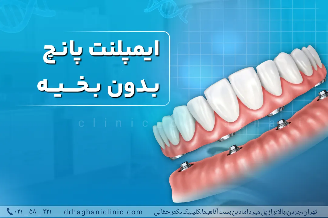ایمپلنت پانچ بدون بخیه در کلینیک دکتر حقانی