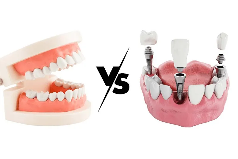 تفاوت ایمپلنت و دندان مصنوعی: کدام روش مناسبتر است؟