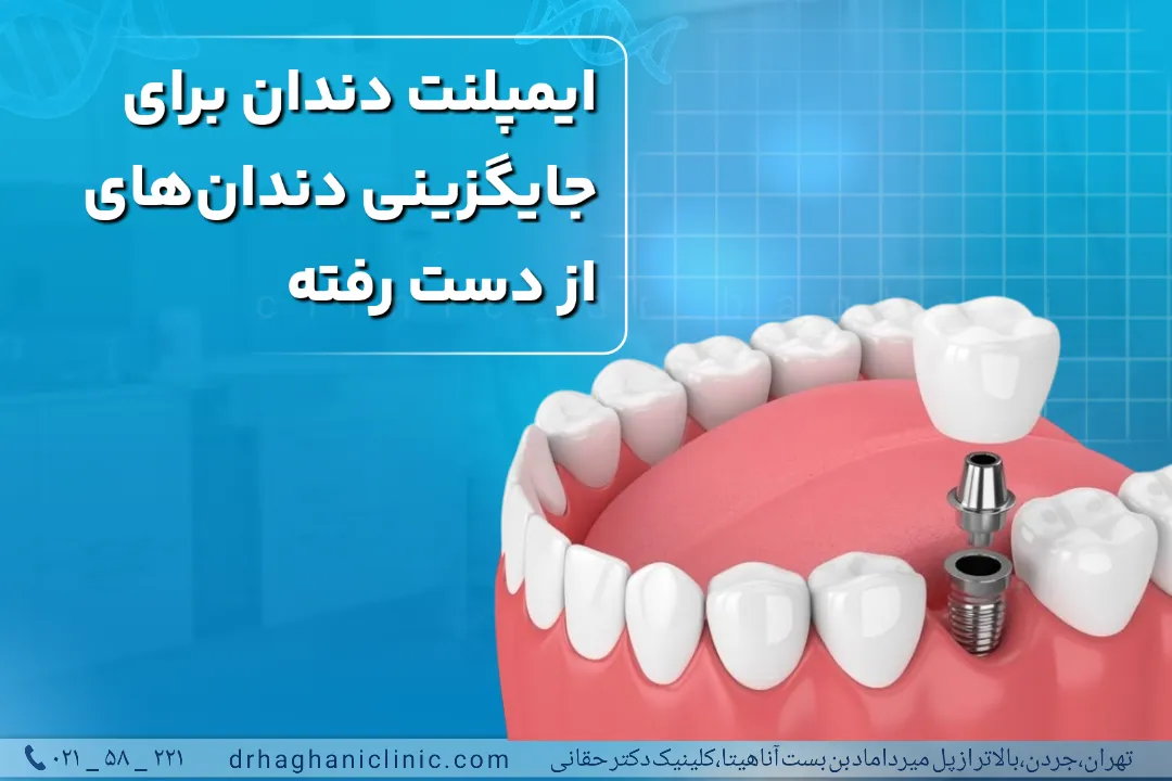 ایمپلنت دندان برای جایگزینی دندان از دست رفته