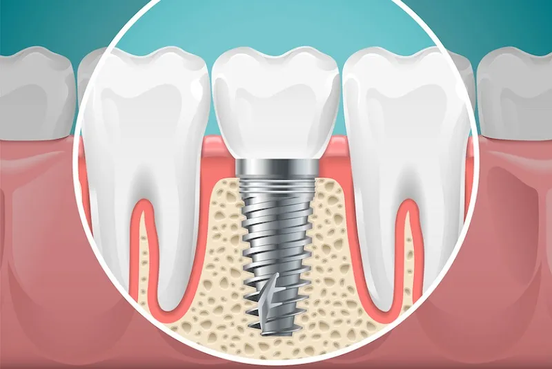 معرفی ایمپلنت دندان