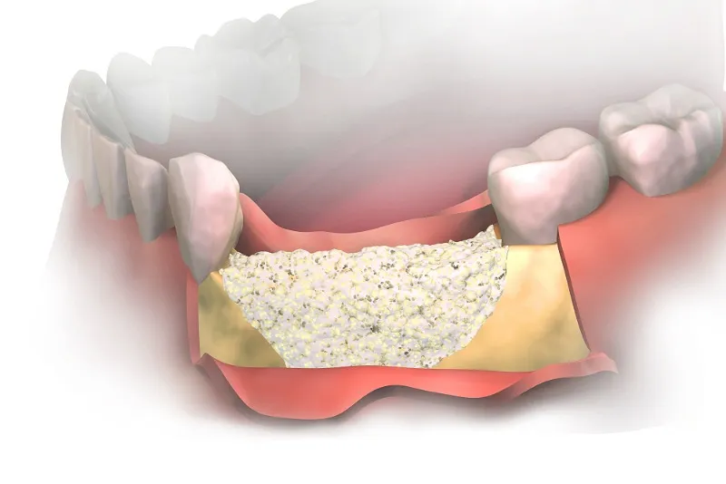 جراحی لثه و علائم احتیاج به جراحی لثه