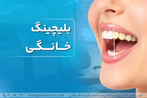 بلیچینگ در خانه آسان