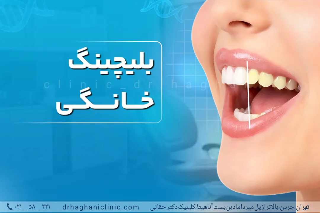 بلیچینگ در خانه آسان