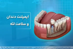 ایمپلنت دندان و سلامت لثه
