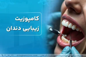 کامپوزیت زیبایی دندان
