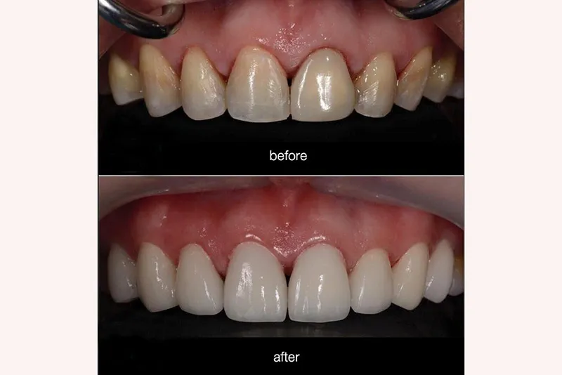 معرفی کامپوزیت ونیر