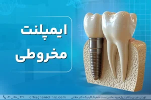 ایمپلنت دندان مخروطی