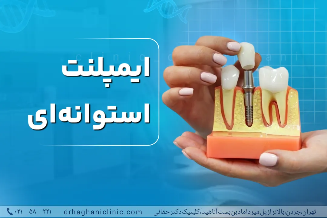ایمپلنت دندان استوانه‌ای